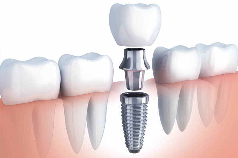 Dental Implants in Rocklin
