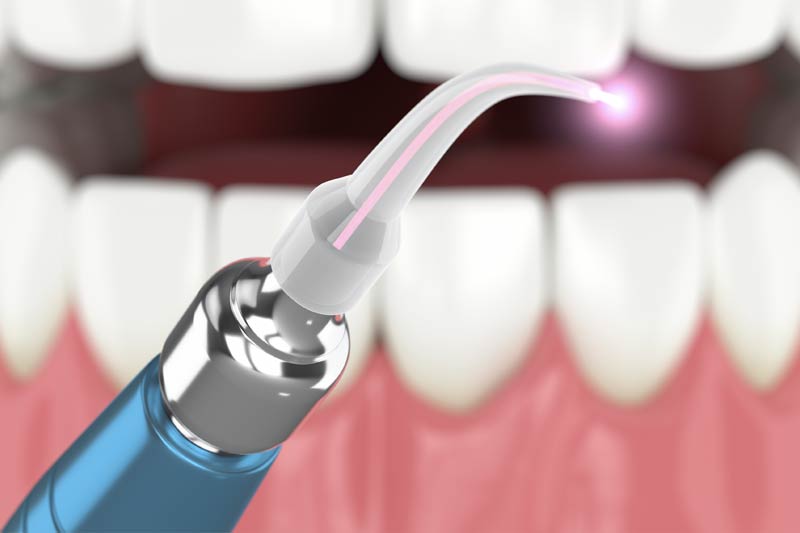 Laser Dentistry in Rocklin