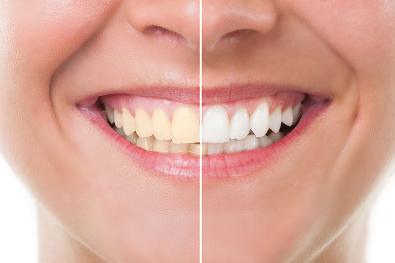 Teeth Whitening in Rocklin